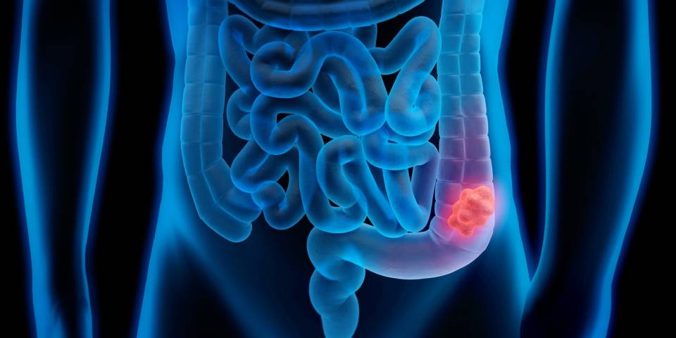 Colorectal Cancer Image