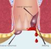 Anorectal Bleeding? Do Not Ignore Anorectal Bleeding - Dr. Pinak Dasgupta