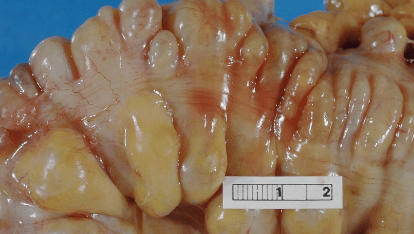 Diverticular disease